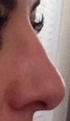 8 months post op