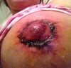 4 days after benelli lift and 550cc implant