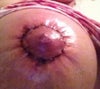 Right breast both are no improvement on either breast and now I have a hard lump right under the incision on both breast