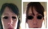 Front on photo ( before nose job on the left)