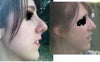 Profile photo ( after nose job on the left)