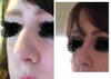 left angle photo ( before nose job on the left)