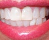 My teeth with 1 veneer giving illusion of straight teeth. I hate my fat front teeth, and they slightly overlap the side teeth.