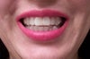 Removal of veneer and some problem back teeth. Got Invisalign.