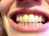 Gums 1