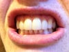 Gums 2