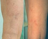 Vein Treatment Before and After Photos
