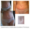 I have Photoshopped what I hope can be achieved with an umbilicoplasty and fat transfer (to fill the dent above my navel). Am I dreaming? If the shape ca be achieved, where would the scars be located?