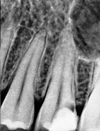 Before root canal