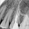 After root canal