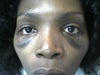6 WEEKS AFTER SURGERY WHY IS MY TEAR TROUGHS SAGGING WITH SKIN AND LOOKS SWOLLEN