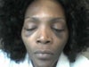 6 WEEKS AFTER SURGERY WHY IS MY TEAR TROUGHS SAGGING WITH SKIN AND LOOKS SWOLLEN