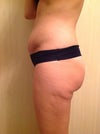 After TT at 9 weeks side view