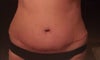 Puffiness at ends of incision