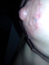 Bumps on aureola are extremely hard and painful. They are not pimples but ends of stitches trying to eject from under the skin
