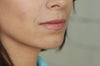 Horizontal line at rest pre-Botox