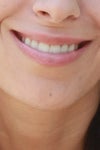 Horizontal dynamic line when smiling post-4 units Botox
