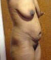 I'll be getting a TT after recovering from my breast lift.
