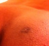 Abscess scar