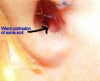 Image of semi-blocked nostril