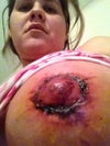 1 week post op