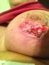 Today which is 4 weeks 3 day post op... I'm scared it just keeps spreading