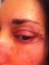Right eye corner
