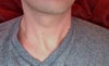 About 5 dark freckles on my neck