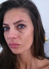 After Juvederm injection
