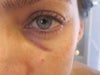 After Juvederm injection