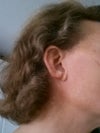 Right ear with congenital cleft lobe.
