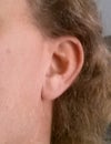 Normal left ear, perhaps with enough donor tissue to repair the right?