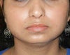this is my chin Before