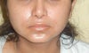 chin after Implant