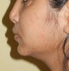 chin after Implant