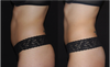 VASER Shape Before and After Photos