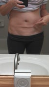 The indent/lip left over after lipo