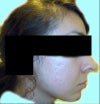 without fillers.  also would like advice on what to do with acne scars.