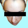 post-fillers (4 months).  very crooked nose.