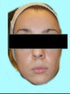 post-fillers (4 months).  very crooked nose.