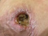 This is before treatment