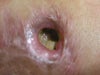 This is after treatment
