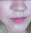 This is before perlane injection.