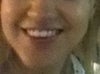 After perlane - nasolabial folds slightly decreased but nose flare still prominent