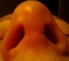 Primary Rhinoplasty Columella Scar