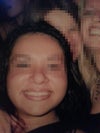 This is after the 1st surgery, my nose is droopy and bolbous on the end and slightly crooked.  Sorry I don't have a better picture