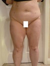 Note: the little scars on my stomach are from a large fibroid removal and uterine resection in Jan. 2012. My upper inner thighs do not feel like there is fat there, but I am unhappy with not being able to see between my legs as well. I did have a tiny space between them 2 months after surgery. My weight prior to surgery was 183. I am 5.1. I am now 168. He removed 1 gallon of fat. I have adjusted my diet and am exercising and plan to shed more pds @ my stomach and legs.