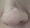 Lowered scar on my nose.