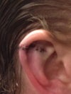 Normal procedure where ear size is reduced, horizontal cutting.