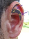 Vertical cutting to reduce prominent antihelix.